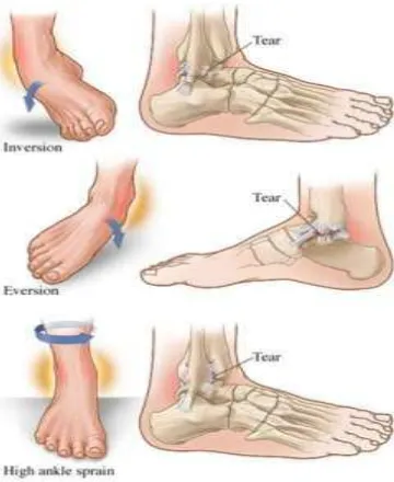 Gambar 3. Inversion, Eversion, and High (lateral) Ankle Sprain. Sumber: http://www.ismc.co.id/ 