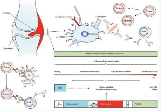 Gambar 1. Patogenesis dari Artritis Reumatoid (6)