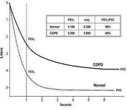 Gambar 1.1 Perbandingan spirometri pasien PPOK dan orang normal 