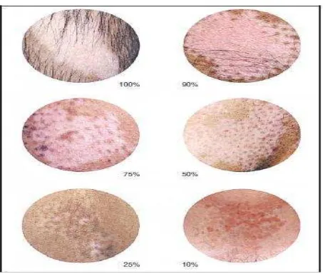 Gambar 2.1. Panduan untuk memperkirakan derajat pigmentasi pada vitiligo (Hamzavi dkk., 2004) 