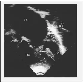Gambar 11. Ekokardiografi double inlet right ventricle dengan stenosis pada