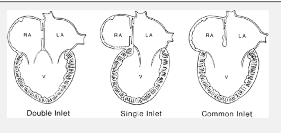 Gambar 1. Klasifikasi univentricle berdasarkan hubungan katup AV dengan ventrikel. 1