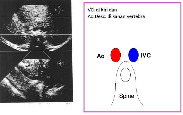 Gambar 5. Situs inversus, vena kava inferior di kiri aorta desende di kanan vertebra