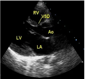 Gambar 1. Pandangan Sumbu Panjang Parasternal pada tetralogy fallotKeterangan: RA (right atrium), RV (right ventricle), LV (left ventricle), LA (leftatrium), RV (right ventricle), Sinus coronaries, MV (mitral valve) dan AV (aortavalve), LV (left ventricle)