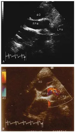 Gambar 2 Pandangan Sumbu Pendek Parasternal pada pasca bedah TetralogyFallot, ditemukan residual Pulmonal stenosis