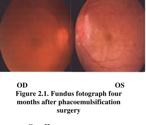 Figure 2.1. Fundus fotograph four