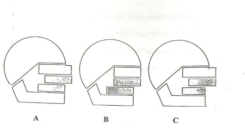 Gambar 2.4   Bermacam-macam keadaan kelas II skeletal A. Maksila terhadap kranium prognati, mandibula normal B
