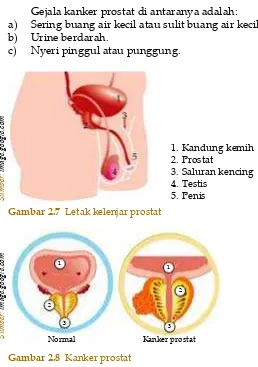 Gambar 2.8  Kanker prostat