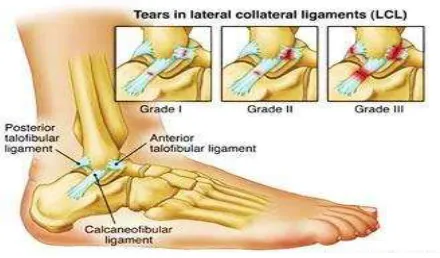 Gambar 2.17. Ankle sprainsSumber: http://www.healingfeet.com dipostkan Jenn F. pada  Kamis, 17 April 2014, diunduh 27/11/ 2014, pk.14.00  