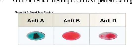 Gambar berikut menunjukkan hasil pemeriksaan golongan darah Pak Ali. 