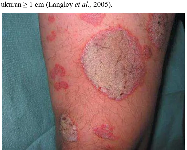 Gambar 2.2 Lesi Psoriasis : Plak Numular (bentuk seperti koin) 