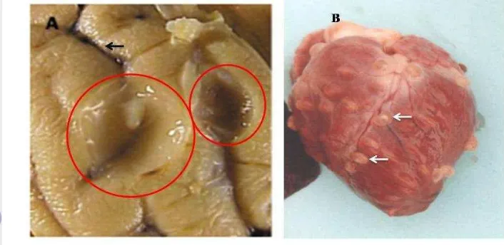 Gambar 3  Infiltrasi Cysticercus cellulosae pada organ tubuh: otak manusia (tanda 