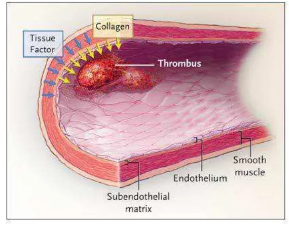 Gambar 2.1. Trombus pada pembuluh darah (NEMJ, 2008) 