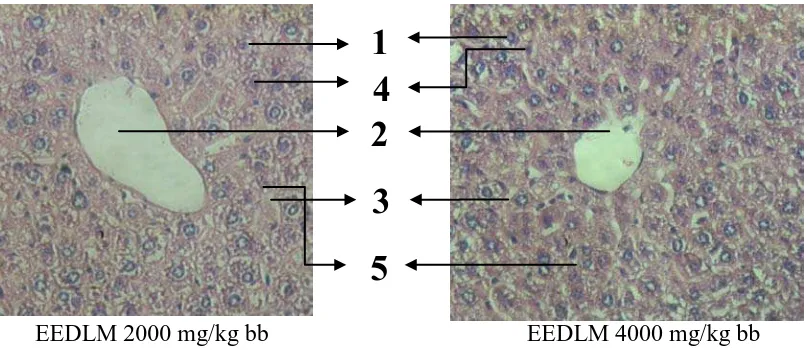 Gambar 4.3 Histopatologi hati mencit dengan pemberian EEDLM  2000 mg/kg bb dan 4000 mg/kg bb  