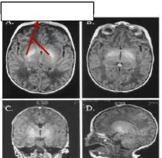 Gambar 1 Kristal bilirubin di dalam jaringan otak bayi   Acute Bilirubin Encephalopaty (2) 