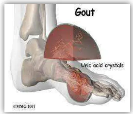 Gambar 2.3 Peradangan pada pangkal ibu jari kaki (gout) akibat kadar asam urat  darah yang tinggi
