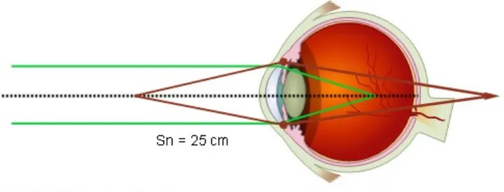 Gambar lensa silindris untuk mata astigmatisma