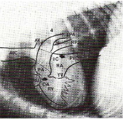 Gambar 18     Radiografi jantung anjing dan jalur peredaran darah di dalam jantung sebelah kanan  pada posisi lateral, (AVC) cranial vena cava, (AV) persimpangan vena azygos  dengan AVC, (RU) aurikel kanan, (RV) ventrikel kanan, (CA) conus areteriosus, (PA