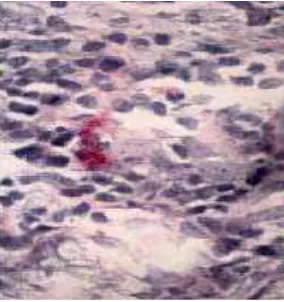 Gambar 2.1: Gambar histologi  menunjukkan infeksi H. pylori(Lamina propiria pada 
