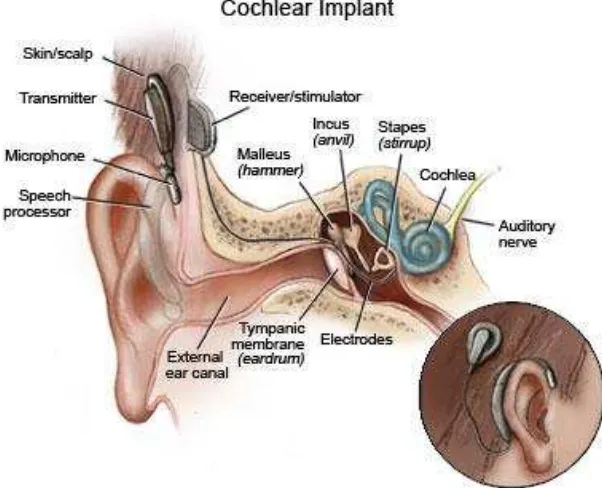Figure 2.4 Cochlear implant 