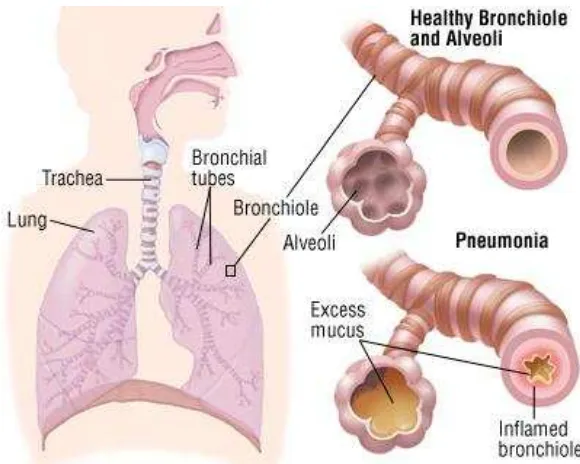 Gambar 1. Pneumonia (Harvard Health Publications) 