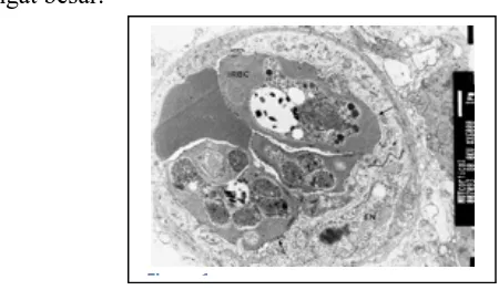  Gambar 1. Perlekatan P-RBC pada permukaan endotel vaskuler Figure 1 