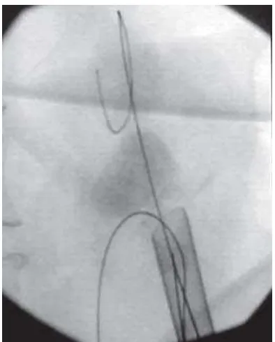 Gambar 2.7. Nefroskopi dan ekstraksi batu dengan C-arm fluoroskop sebagai           pengkonfirmasi pembersihan