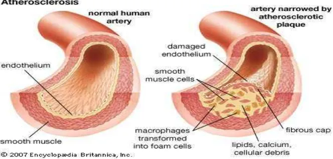 Gambar 2.5  Atherosklerosis pada Dinding Pembuluh Darah (http://healthhabits.files.wordpress.com)  