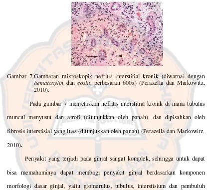 Gambar 7.Gambaran mikroskopik nefritis interstitial kronik (diwarnai dengan hematoxylin eosin