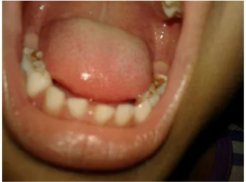 Gambar 10. Keluhan Kesehatan Gigi Oleh Warga Yang Penggunaan Air  Gambut Yang Mengakibatkan Pengeroposan Gigi 
