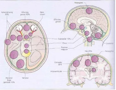 Gambar 2,1. Variasi lokasi timbulnya meningioma (Al-Mefty, 2005) 