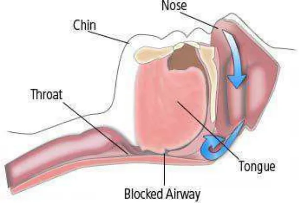 Gambaran 2.3Obstruktif sleep apnea(Dorinda 2007). 