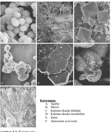 Gambar 2.3. Kristal urin Sumber: Ferrandino, M.N., Pietrow, P.K., dan Preminger, G.M., Evaluation and  Medical Management of Urinary Lithiasis