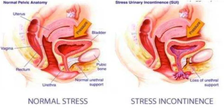 Gambar 2. Perbandingan Normal Stress dan Stress Inkontinensia  (Dikutip dari 27)    