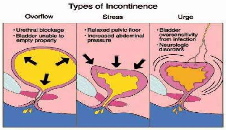 Gambar 3. Tipe Inkontinensia Urin(Dikutip dar 28l) 