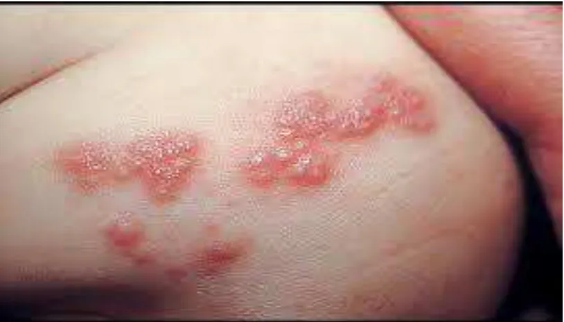 Gambar 2. Herpes-zoster 