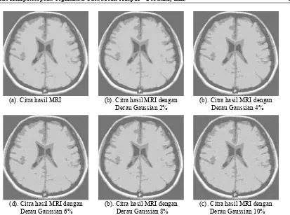 Gambar 5. Hasil segmentasi citra MRI Otak Normal tanpa dan dengan derau