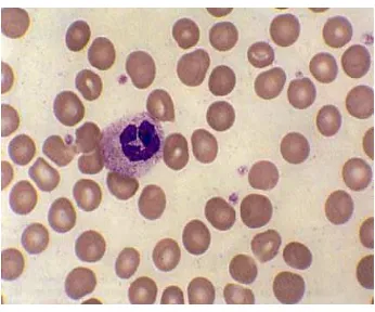 Gambar 7. Gambaran Megakariosit yang bervakuolisasi, kerusakan akibat infeksi virus (Heckner F., Lehmann H