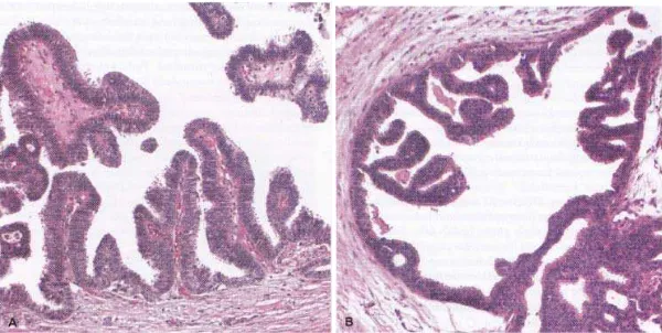 Gambar 4 DCIS nonkomedo. A, DCIS papilaris. Tonjolan fibrovaskular halus meluas ke dalam sebuah duktud dan dilapisi oleh populasi monomorf sel (Crum,2009)