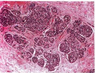 Gambar 5 Karsinoma lobulus in situ. Tampak populasi monomorfik sel kecil bulat 