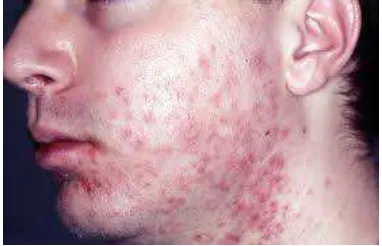 Gambar 2.3. Penyakit kulit yang disebabkan oleh S. aereus