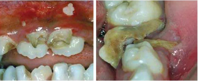Gambar 1. Pulpitis6 