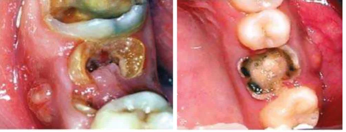 Gambar 3. Fistula6 