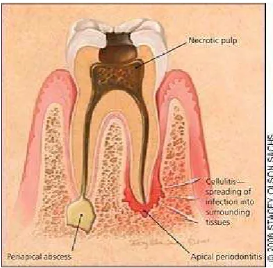 Gambar 4. Abses periapikal6