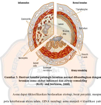 Gambar 3. Ilustrasi kondisi patologis bronkus normal dibandingkan dengan bronkus asma akibat inflamasi dan airway remodeling  