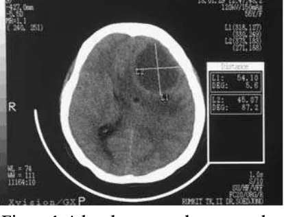 Figure 1. A head computed tomography (CT)-scan conﬁ rmed multiple lesion in the frontal area