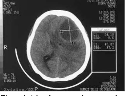 Figure 1. A head computed tomography (CT)-scan conﬁ rmed multiple lesion in the frontal area