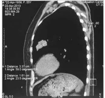 Figure 2a and b. Suspected lung mass of  the left medial lobe (2.5x2cm)