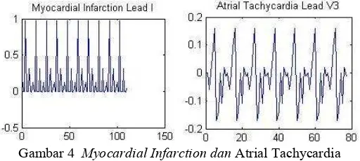 Tabel 2  Data Myocardial Infarction 