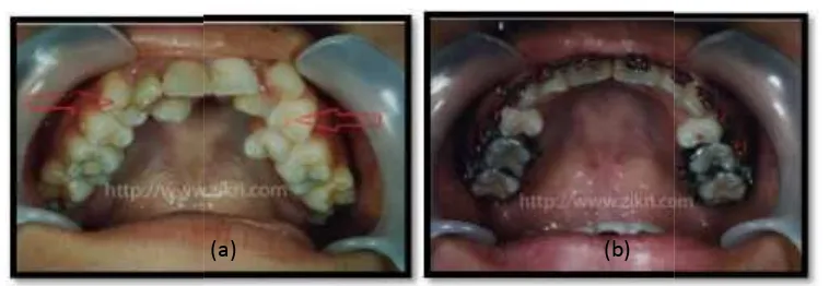 Gambar 2.2 2.2 P Penerapan kawat gigi sebelum (a) dan sesudasudah (b)[9]
